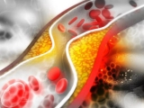 Cholesterol cao là nguyên nhân phổ biến gây xơ vữa động mạch, nhồi máu cơ tim