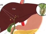 Sỏi gan là gì?