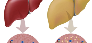 Làm thế nào đảo ngược tình trạng gan nhiễm mỡ
