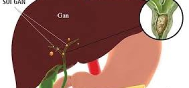 Sỏi gan là gì?
