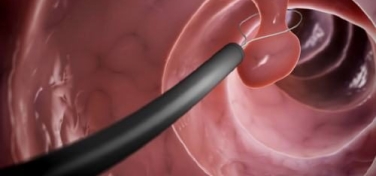 U Dạ Dày Lành Tính 