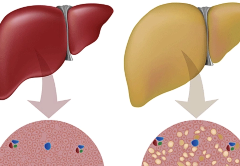 Làm thế nào đảo ngược tình trạng gan nhiễm mỡ