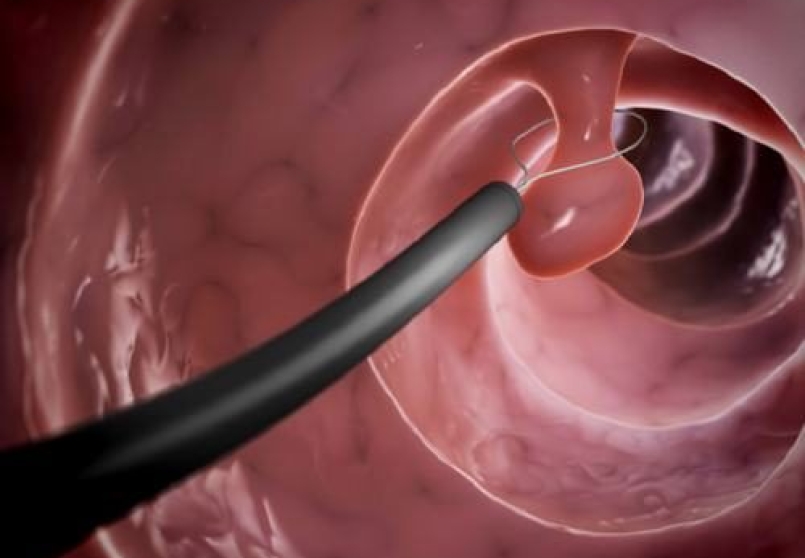 U Dạ Dày Lành Tính 